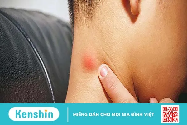 Hạch nhóm 4 có nguy hiểm không? Cách xử lý khi xuất hiện hạch nhóm 4 1