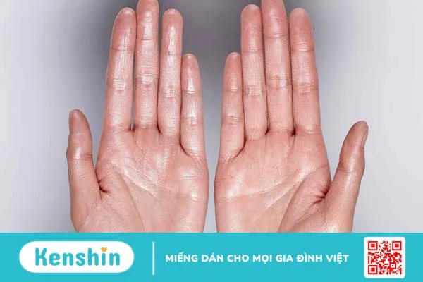 Hạch thần kinh giao cảm và mối liên hệ của triệu chứng đổ mồ cơ thể 2