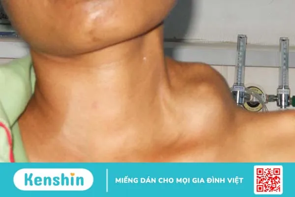 Hạch troisier là gì? Hạch nằm ở đâu và có gây nguy hiểm không? 4