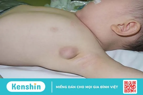 Hạch viêm mạn tính: N 1guyên nhân, triệu chứng, chẩn đoán và điều trị