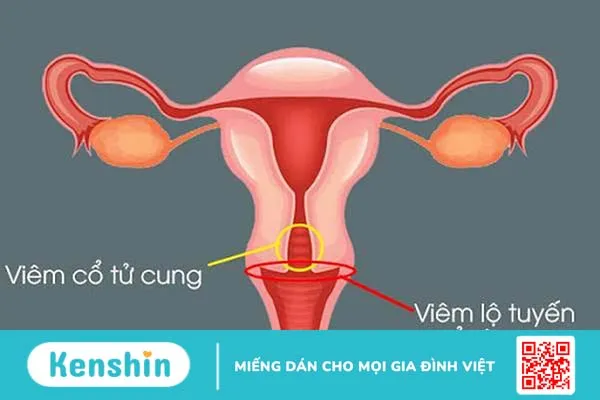 Hậu quả của viêm lộ tuyến cổ tử cung đến sức khỏe phụ nữ mà bạn không nên bỏ qua 1