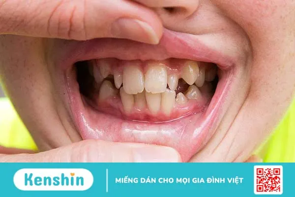 Cha mẹ cần làm gì nếu trẻ nghiến răng khi ngủ? 2