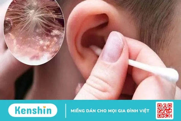 Hiểu về nấm ống tai ở trẻ em để phòng ngừa bệnh hiệu quả 2