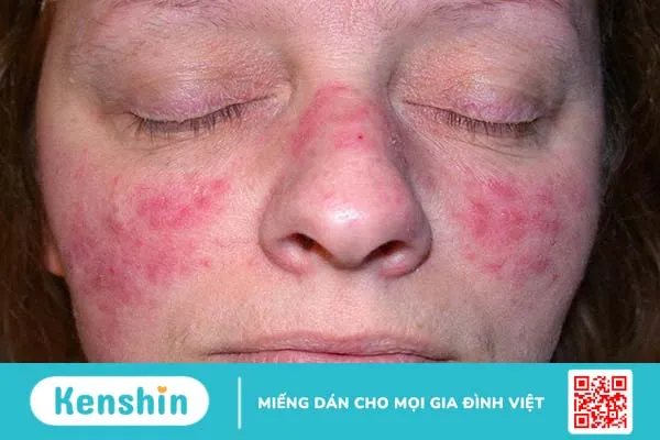 Hình ảnh lupus ban đỏ dạng đĩa thường xuất hiện như thế nào? Triệu chứng lâm sàng và cách điều trị 1