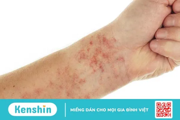 Hình ảnh lupus ban đỏ dạng đĩa thường xuất hiện như thế nào? Triệu chứng lâm sàng và cách điều trị 2