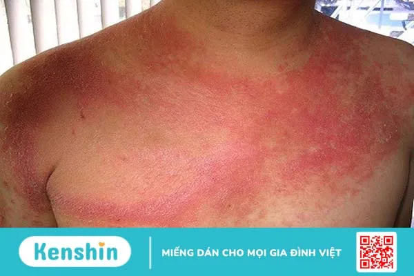 Hình ảnh lupus ban đỏ dạng đĩa thường xuất hiện như thế nào? Triệu chứng lâm sàng và cách điều trị 3