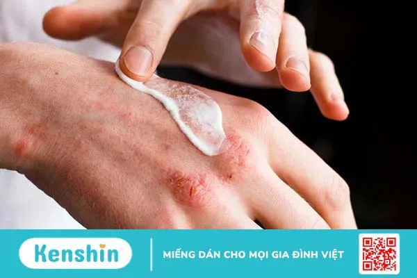 Hình ảnh lupus ban đỏ dạng đĩa thường xuất hiện như thế nào? Triệu chứng lâm sàng và cách điều trị 4