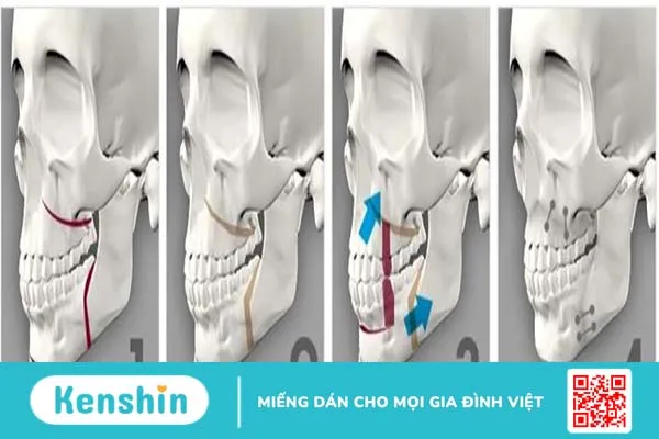 Hô hàm dưới: Nguyên nhân, tác hại và phương hướng khắc phục 4