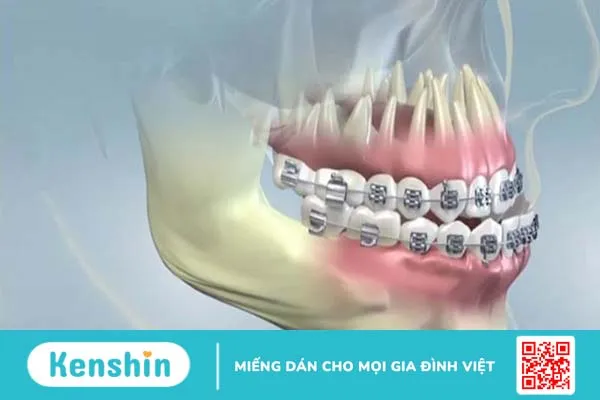 Hô hàm dưới: Nguyên nhân, tác hại và phương hướng khắc phục 6