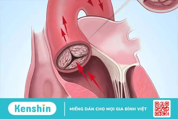 Hở van động mạch chủ 1/4 có nguy hiểm không? 1