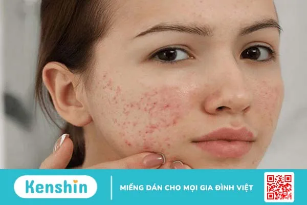 Học ngay cách trị mụn đỏ 2 bên má đơn giản và hiệu quả tại nhà 1