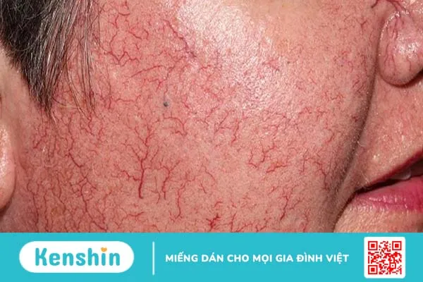 Hội chứng Carcinoid