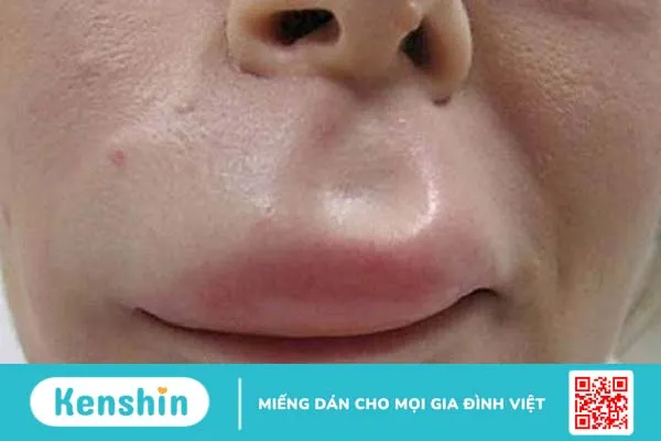 Hội chứng dị ứng miệng và những điều cần biết