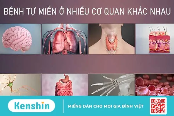 Hội chứng nhược cơ Lambert-Eaton: Dấu hiệu, nguyên nhân và cách điều trị 3