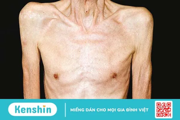 Hội chứng suy mòn Cachexia : Nguyên nhân, triệu chứng, hướng điều trị 1