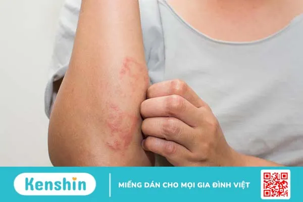 Hội chứng tăng IgE là gì và có nguy hiểm không 1