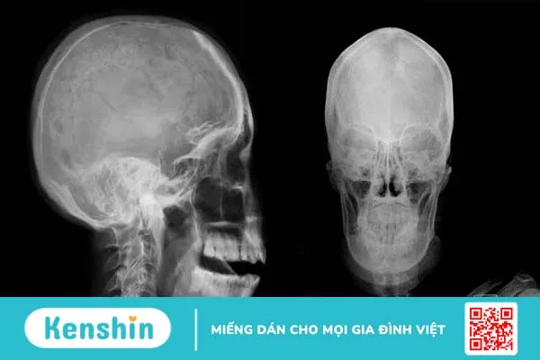 Hội chứng tiền đình Phương pháp điều trị hiệu quả và chẩn đoán chính xác 2