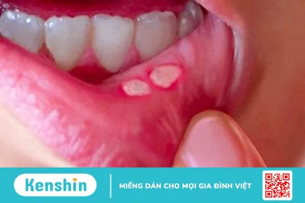 Viêm loét miệng gây đau, khó chịu ở bệnh nhân điều trị ung thư