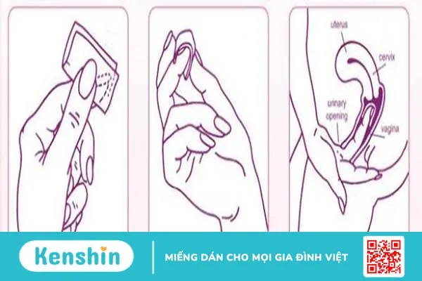 Hướng dẫn cách sử dụng màng tránh thai 2