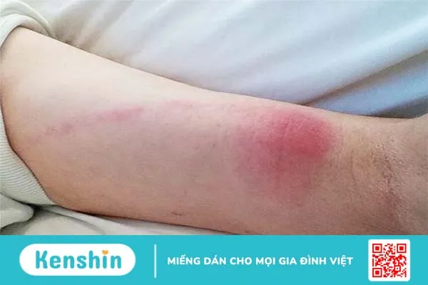 Hướng dẫn điều trị viêm mô tế bào đúng cách 1