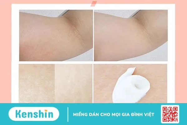 kem trị rạn da sau sinh rep 4