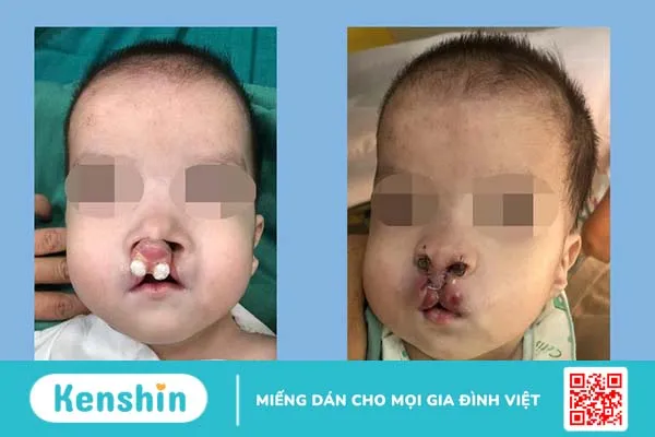 Khe hở vòm miệng: Nguyên nhân và lưu ý khi điều trị 3