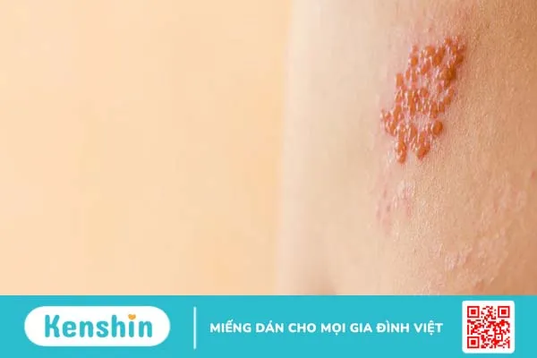 Biểu hiện thường gặp của bệnh giời leo