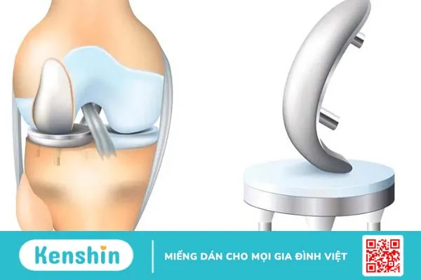 Khi nào cần thực hiện phục hồi chức năng sau thay khớp gối? 1 1