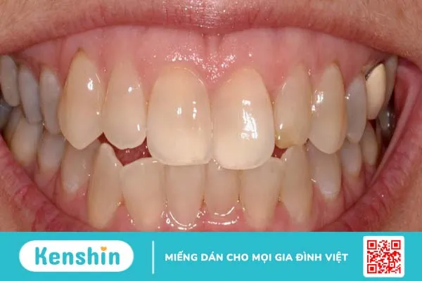 Cần chăm sóc răng miệng sau khi tẩy trắng răng