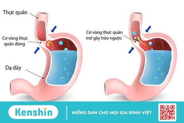 Không còn nỗi lo trào ngược dạ dày thực quản với Marial Gel 1