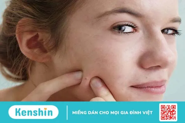 Không nặn mụn có tự hết không? 2