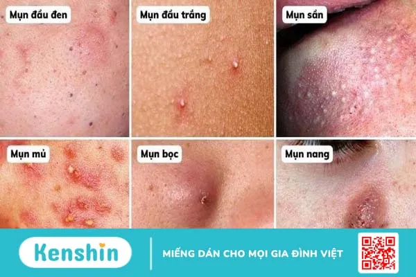 Không nặn mụn có tự hết không? 4