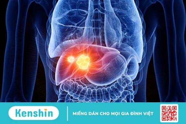 Kỹ thuật chụp động mạch gan số hoá xoá nền là gì? Chỉ định và chống chỉ định  2