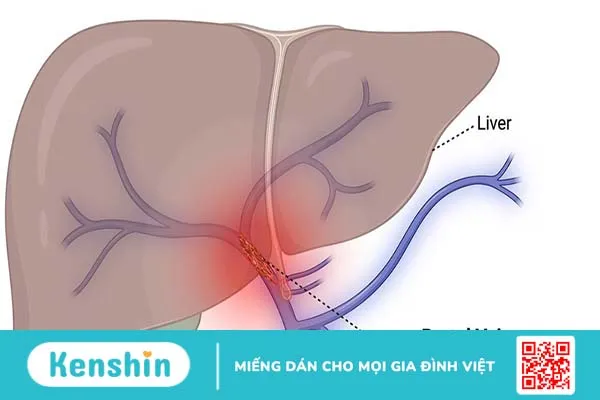 Kỹ thuật chụp động mạch gan số hoá xoá nền là gì? Chỉ định và chống chỉ định  4