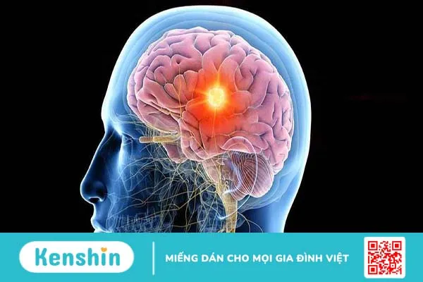 Làm gì với người động kinh sùi bọt mép: Cách xử lý đúng đắn khi gặp phải trường hợp này 2