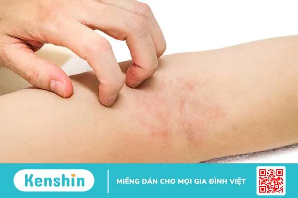 Khi người bệnh gãi quá nhiều sẽ gây cho da những tổn thương