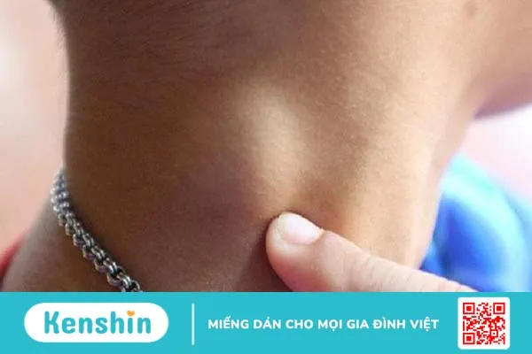 Làm sao để hạch biến mất? Những lưu ý bạn cần biết về hạch 1