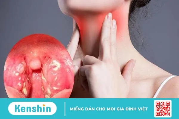 Làm sao để hạch biến mất? Những lưu ý bạn cần biết về hạch 2