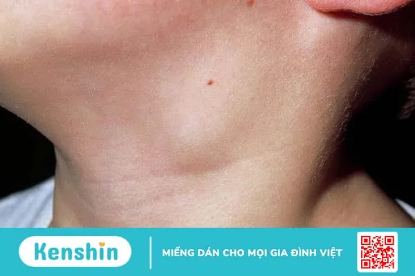 Làm sao để hạch biến mất? Những lưu ý bạn cần biết về hạch 3