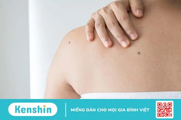 Nốt ruồi xuất hiện ở nhiều vị trí khác nhau trên cơ thể