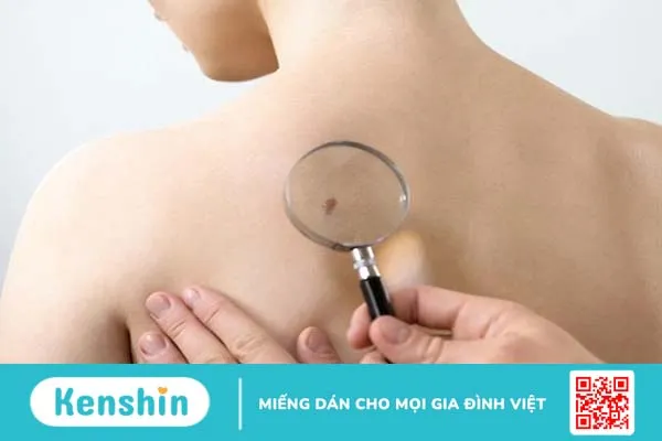 Không nên lạm dung phương pháp tẩy nốt ruồi bằng kem đánh răng