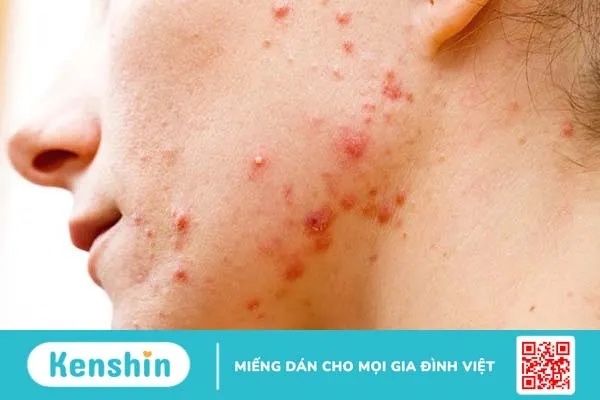 Lăn kim trị mụn bị sưng phải làm sao?