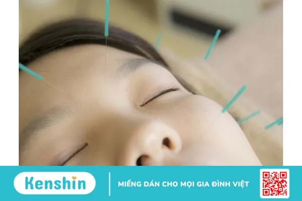 Liệt dây thần kinh số 7 châm cứu bao lâu?