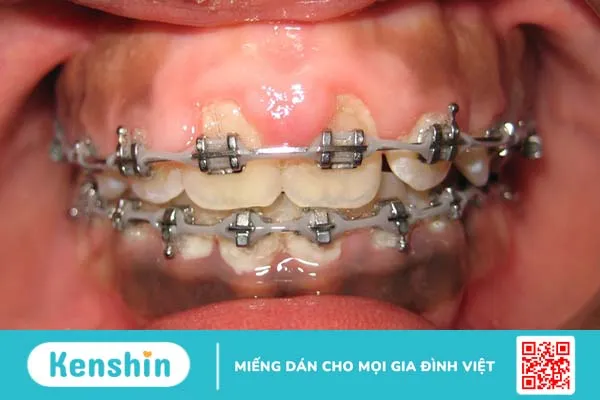 Lợi trùm khi niềng răng: Nguyên nhân, triệu chứng, cách khắc phục 1