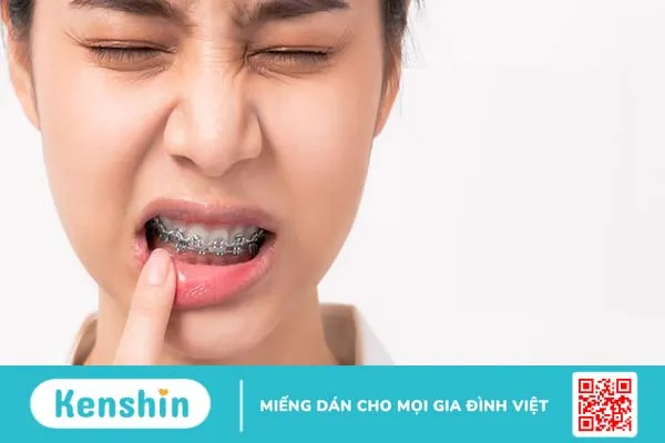 Lợi trùm khi niềng răng: Nguyên nhân, triệu chứng, cách khắc phục 3