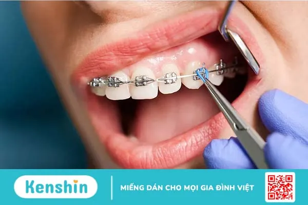 Lợi trùm khi niềng răng: Nguyên nhân, triệu chứng, cách khắc phục 4