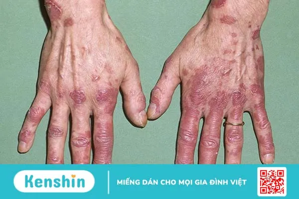 Lupus ban đỏ có mấy loại? Biến chứng của lupus ban đỏ nguy hiểm như thế nào? 1