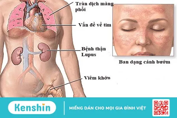 Lupus ban đỏ có mấy loại? Biến chứng của lupus ban đỏ nguy hiểm như thế nào? 2