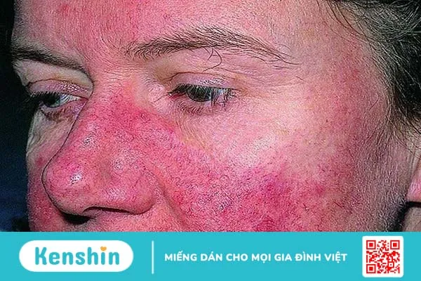 Lupus ban đỏ có mấy loại? Biến chứng của lupus ban đỏ nguy hiểm như thế nào? 3