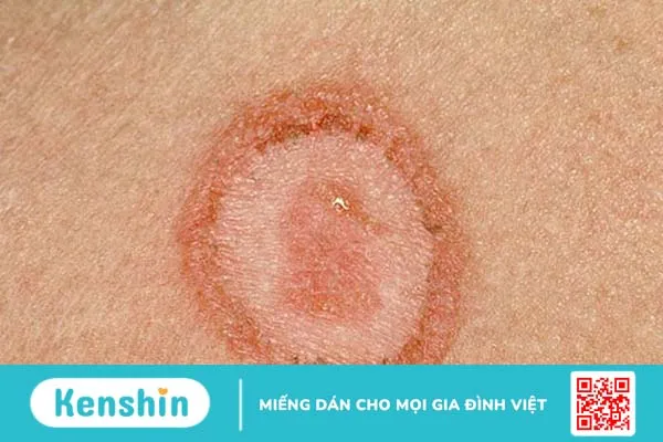 Lupus ban đỏ dạng đĩa có ngứa không? 1